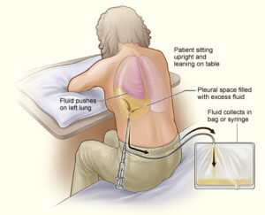 Thoracentesis Procedure: Indications, Ultrasound-Guided Technique, Nursing Care