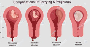 Types of Abortions